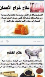 خراج الاسنان والعقم.PNG