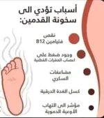اسباب سخونة القدمين.webp