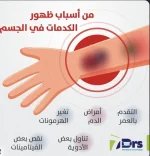 الكدمات.webp