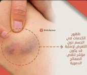الكدمات2.webp