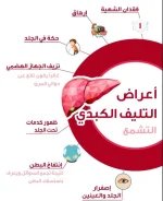 تليف الكبد.webp