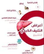 تليف الكبد.webp