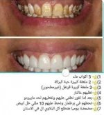 تبييضالاسنان.webp