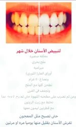 تبييض الاسنان2.webp