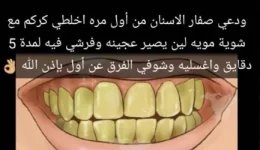 تبييض الاسنان3.webp