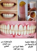 تبييض الاسنان4.webp