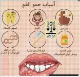 اسباب حمو الفم.webp