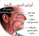 اعراض الجيوب الانفيه.webp