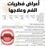 اعراض الفطريات في الفم.webp