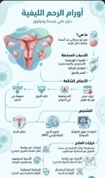 اورام الرحم الليفيه.webp