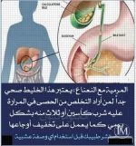 حصى المراره.webp