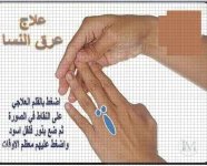 علاج عرق النسا.webp