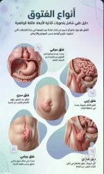 انواع الفتاق.webp