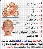 ضرر هز الطفل.webp