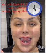 لازالة الخطوط بجانب الفم.PNG لازالة الخطوط بجانب الفم.PNG
