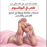 علامات نقص البوتاسيوم.PNG